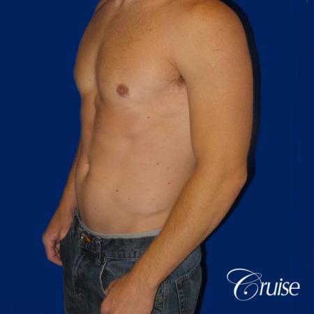 body builder puffy nipple gynecomastia - After 3