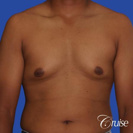 24 yr. old gets gynecomastia surgery with best scars - Before Image 1