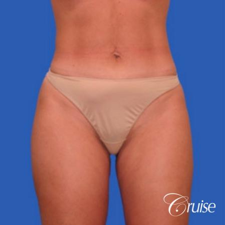 best liposuction abdomen flanks medial and lateral thighs dramatic - After Image