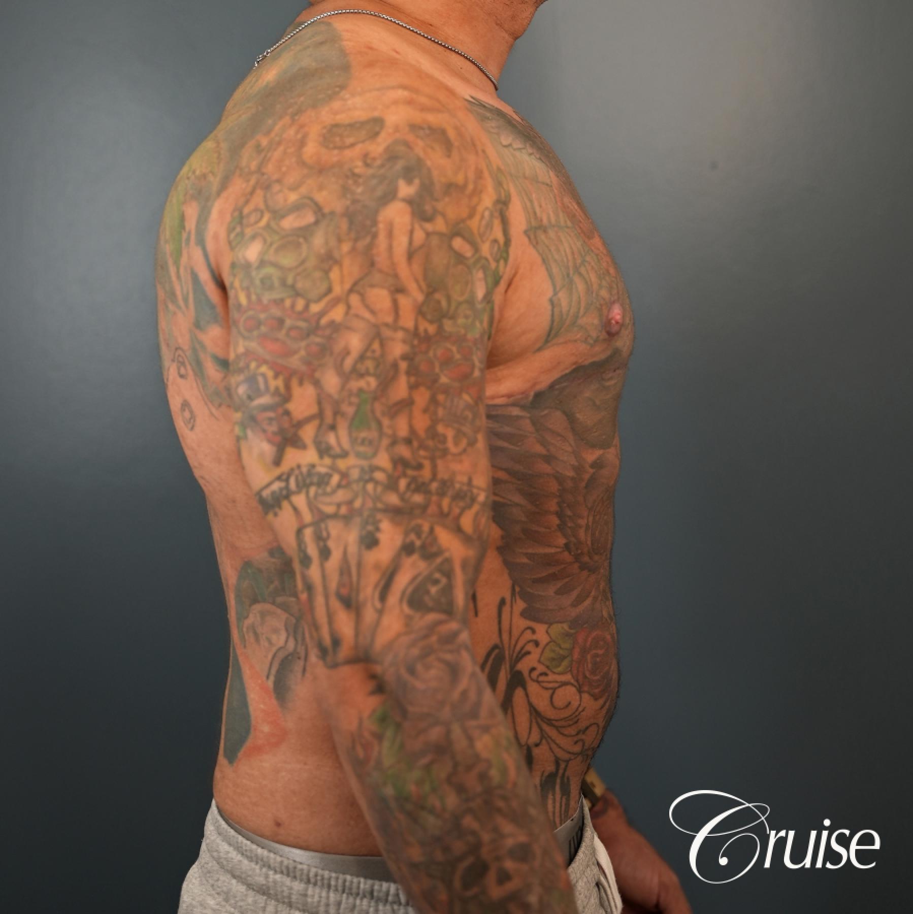 Gynecomastia: Patient 136 - After 4