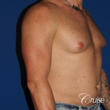 moderate gynecomastia with puffy nipple on athletic adult - Before Image 4