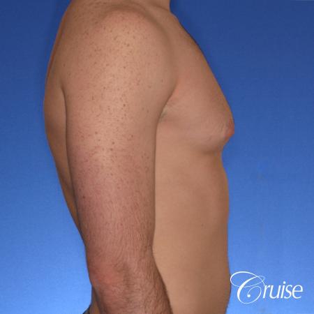 body builder with puffy nipples gets gyne surgery - Before Image 4