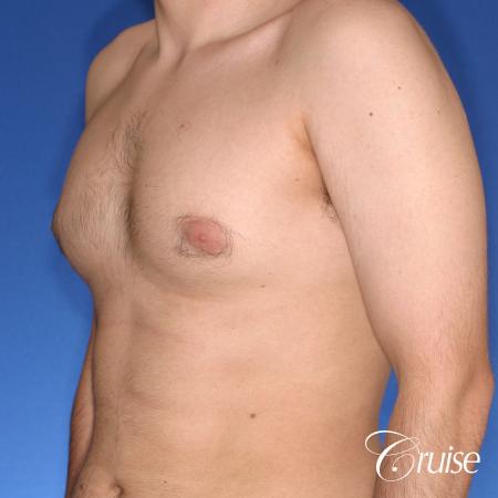 moderate gynecomastia puffy nipple - Before Image 3