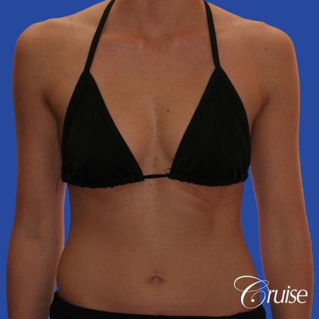 Breast Augmentation - Before and After Image 4
