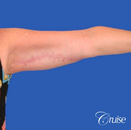 best arm lift newport beach - After Image 1