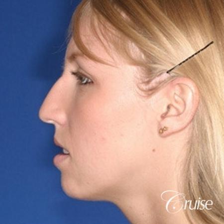 young female with large anatomic chin implant - Before Image 2