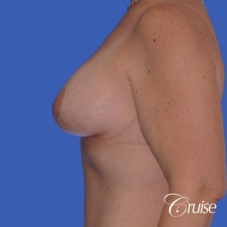 best photos of breast lift anchor on 39 yr old - After Image 2