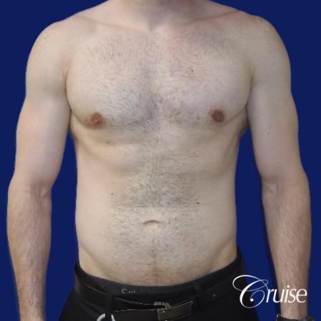 Moderate Gynecomastia -Areola Incision - After Image 1
