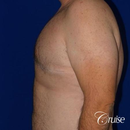 Severe Gynecomastia -Free Nipple Graft - After Image 3