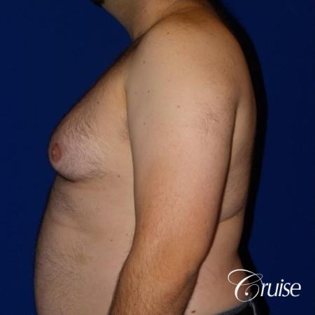 Severe Gynecomastia- Free nipple Graft - Before and After Image 3