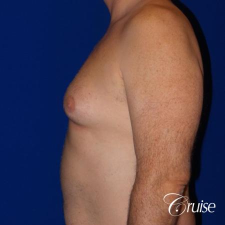 gynecomastia surgery results - Before and After Image 3