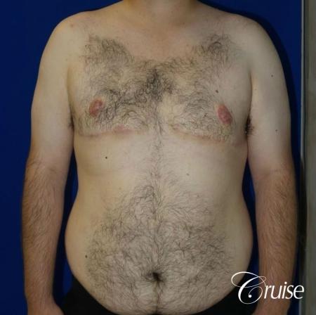 gynecomastia with free nipple graft - 1 After Image 1