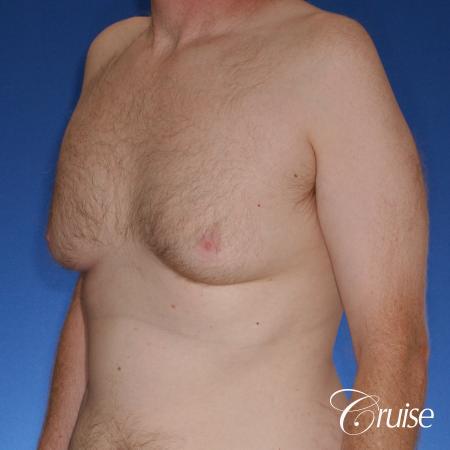 best donut lift with gynecomastia surgery - Before Image 2