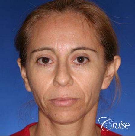 Fat Transfer - Tear Trough, Forehead, Upper Lids, Cheeks - Before Image