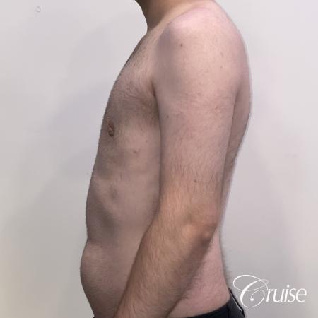 Gynecomastia: Patient 128 - After 2