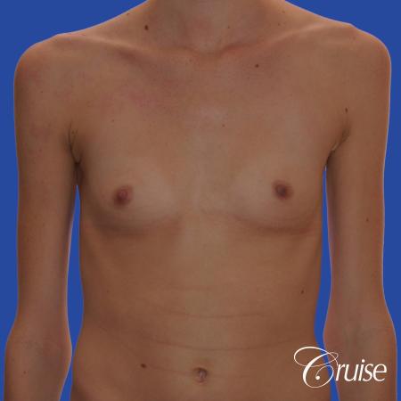 Breast Augmentation - Before Image 1