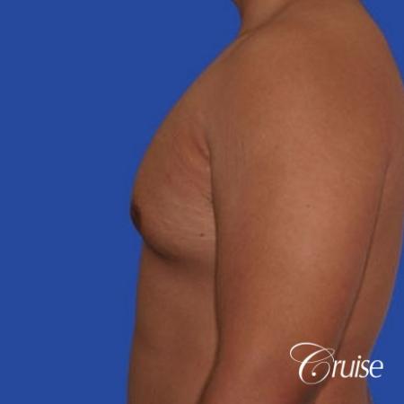 mild gyne on 24yr old adult - Before Image 2