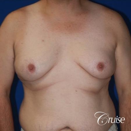 male breast severe gynecomastia free nipple graft anchor - Before Image 1