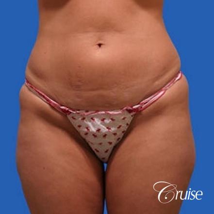 before and after pictures of liposuction abdomen and flanks - Before Image