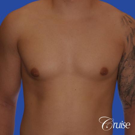 mild gynecomastia with puffy nipple and areola incision - Before Image 1