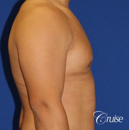 donut lift gynecomastia moderate adult - After Image 3