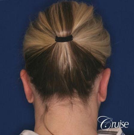 best otoplasty ear surgery by plastic surgeon in Newport Beach - After Image 3