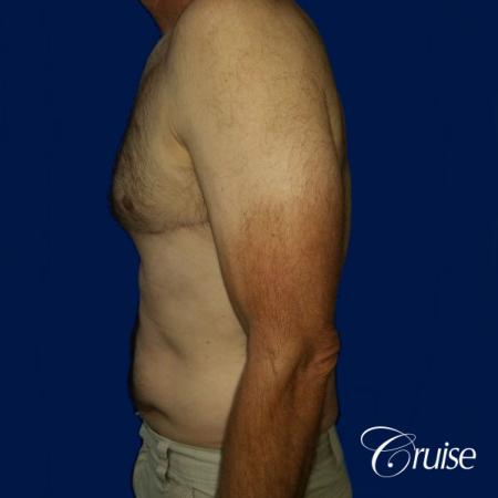 Moderate Gynecomastia Pedicle - After Image 2