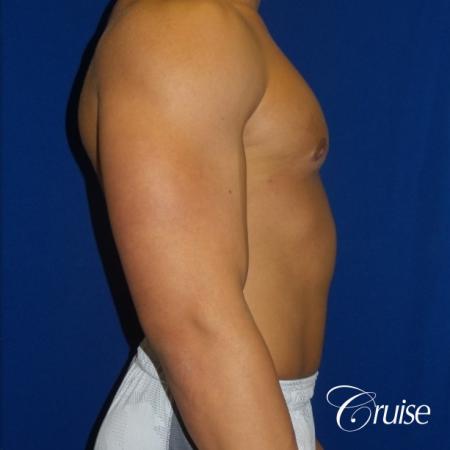 bodybuilder with gynecomastia - After Image 2
