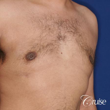 best scar on 32 gynecomastia patient - After Image 3