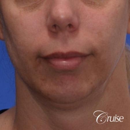 best medium anatomic chin implant on female - Before Image 1