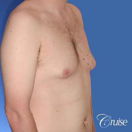 moderate gyne on 31 yr old male - Before and After Image 4
