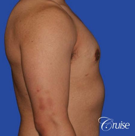 minor gyne young adult with best scars - After Image 3