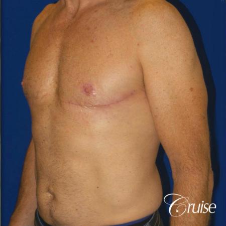 Top Gynecomastia surgeons - After Image 2