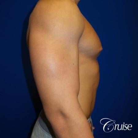 bodybuilder with gynecomastia - Before Image 2