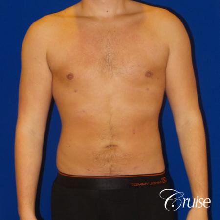 Best before and after lipo photos of guys - After Image 1