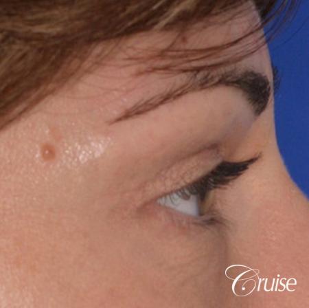 best soft tissue filler using Juvaderm - After Image 2