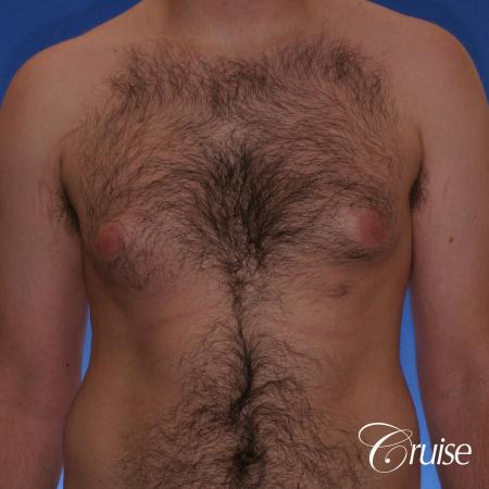 best Puffy nipple correction and gynecomastia on young adult - Before Image 1