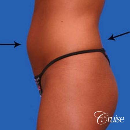 best liposuction abdomen and love handles - Before Image 2