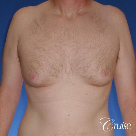 best donut lift with gynecomastia surgery - Before Image 1