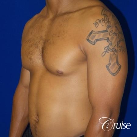 gynecomastia caused by testosterone - Before and After 3