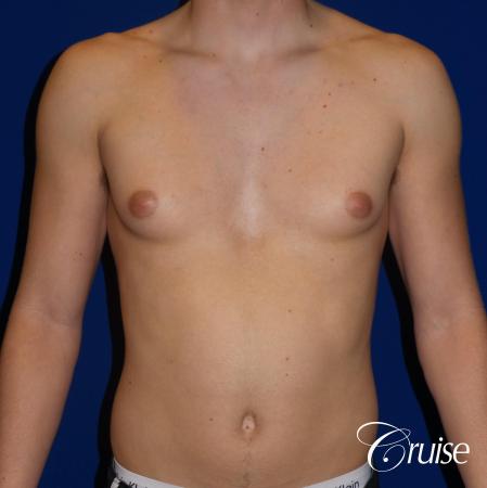 Best moderate gynecomastia on male adult - Before Image 1