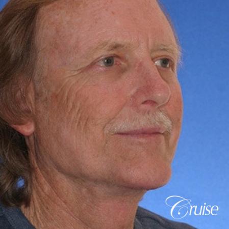 62 yr old with medium square chin augmentation - After Image 3