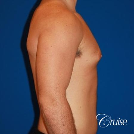 athletic adult with puffy nipple - Before and After Image 4