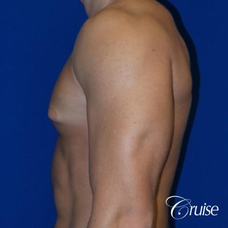 male breast reduction surgery newport beach - Before and After Image 3