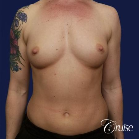 Breast Augmentation - Before 1