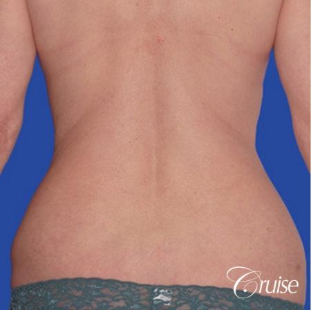 low mini tummy tuck with D cup breast augmentation - Before and After Image 3