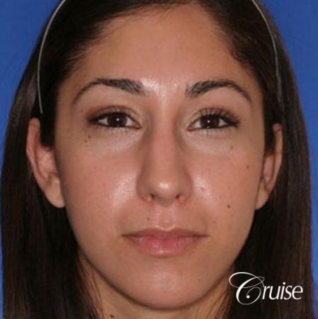 anatomic chin implant with top plastic surgeon in Newport Beach - After Image 1