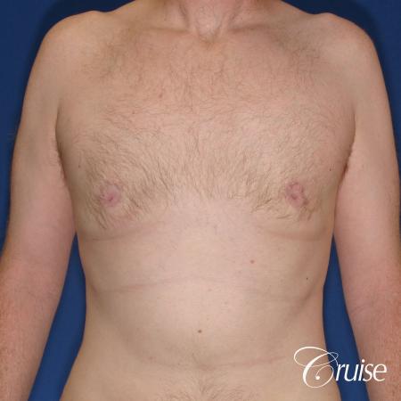 best donut lift with gynecomastia surgery - After Image 1