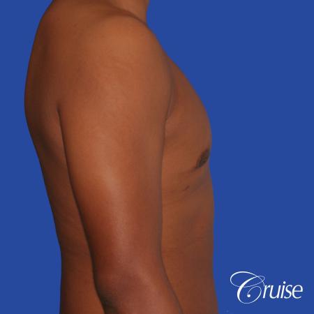 24 yr. old gets gynecomastia surgery with best scars - After Image 3