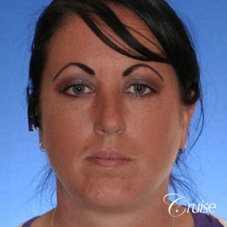 before and after photos of female chin implant - After Image 1
